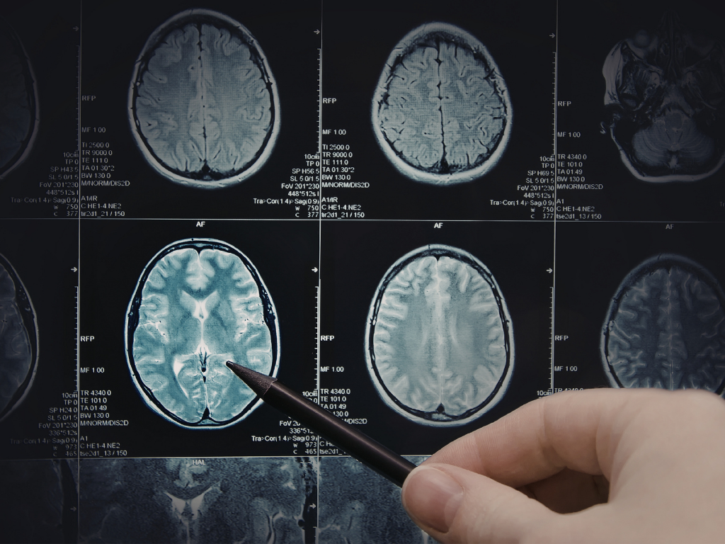 AVC: A Importância da Prevenção e do Diagnóstico Precoce