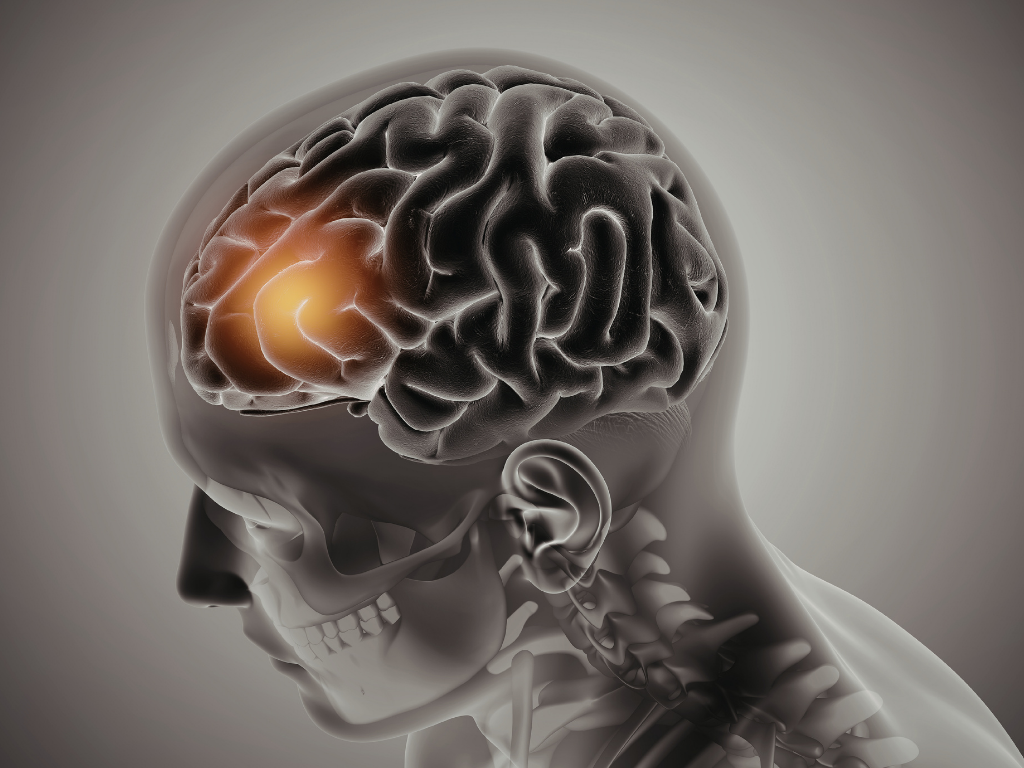 AVC: Reconhecer os Sinais Pode Salvar Vidas